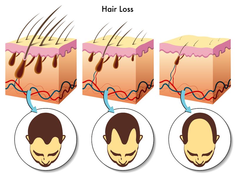 TYPES AND CAUSES OF HAIR LOSS